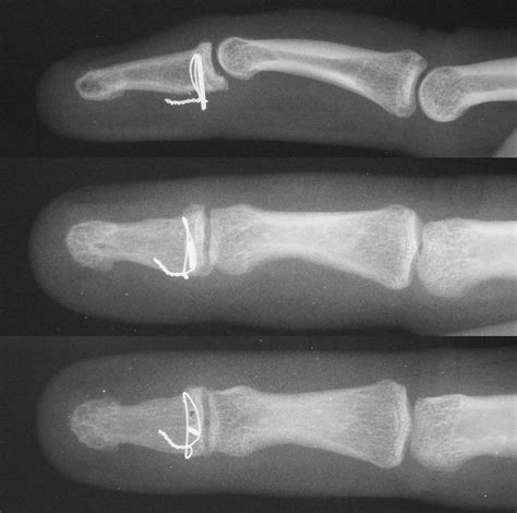 Distal Phalanx Fracture