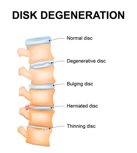 Stages of Degenerative Disc Disease