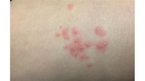 Las 4 Causas De Manchas Rojas En La Piel: Una Exploración Del Dermatólogo