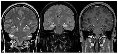 Morphological and Advanced Imaging of Epilepsy: Beyond the Basics