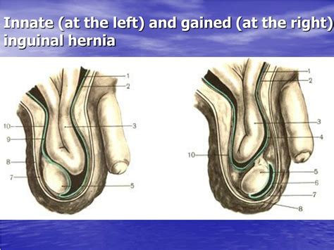PPT - Inguinal , umbilical , femoral hernias PowerPoint Presentation, free download - ID:236616