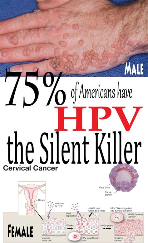 are warts on hands hpv