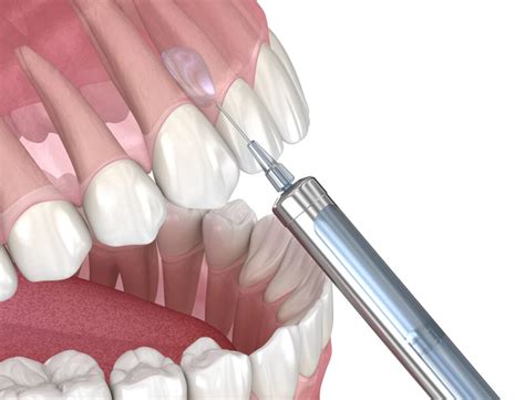 Infiltration Anesthesia 的图像结果