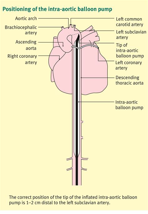 The intra-aortic balloon pump - Surgery - Oxford International Edition