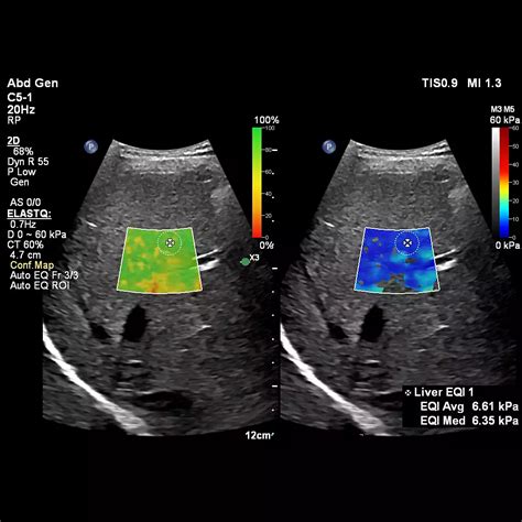 Auto ElastQ Technology - Philips