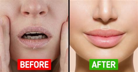 Image result for Pimple From Dry Lips