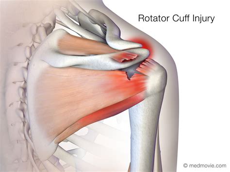 Medmovie.com | Rotator Cuff Injury and Surgical Repair