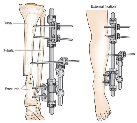 Image result for External Fixation Explained