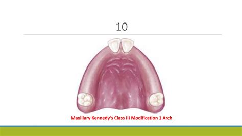 Kennedy’s Classification in Cast Partial Denture | PPTX