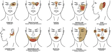 Idiopathic Non-Dental Facial Pain Syndromes in Italian Children: A ...