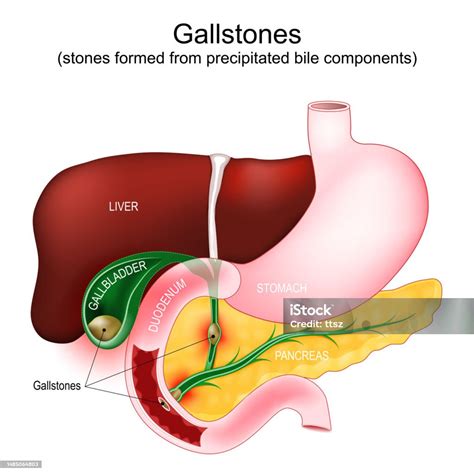 Gallstones Parts Of A Digestive System Gallbladder Duodenum Stomach ...