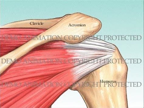 Image result for Subacromial Decompression Rotator Cuff Repair