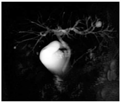 Primary Biliary Cholangitis Associated with Ulcerative Colitis: Case ...