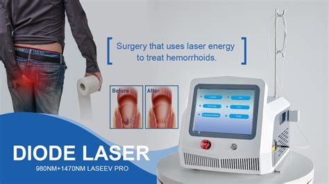 News - What Is Laser Treatment proctology？