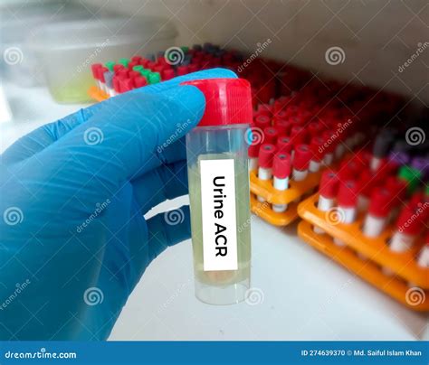 Urine Sample for Urine ACR (Albumin Creatinine Ratio). Diagnosis of Renal Kidney Disease Stock ...