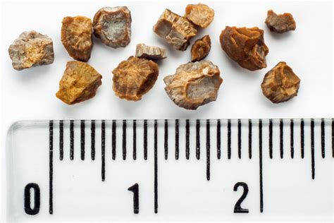 Types of Kidney Stones - Kidney Stones - Urologist - Urology Austin