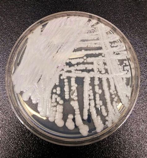 致命真菌——耳念珠菌感染在纽约市以惊人速度传播 | Redian News