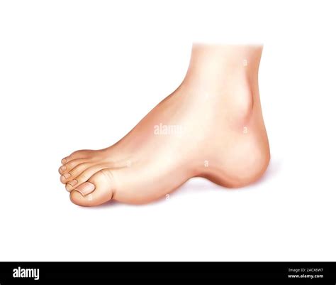 Illustration of the talipes or foot deformations from the anatomical ...
