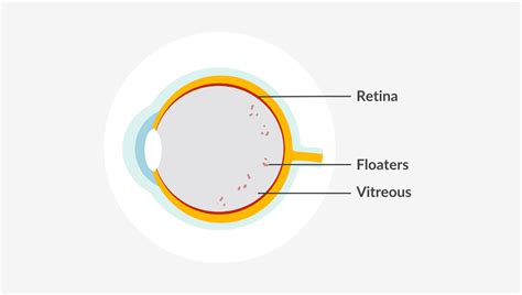 Image result for Eye Floaters Under Microscope