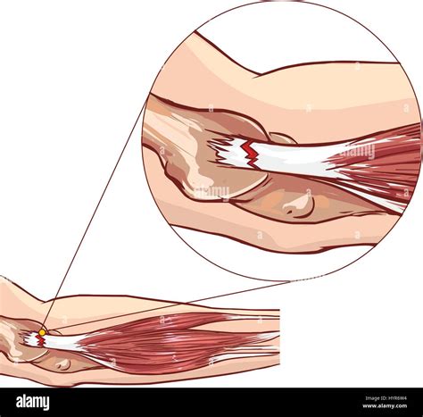 Extensor Tendonitis Elbow