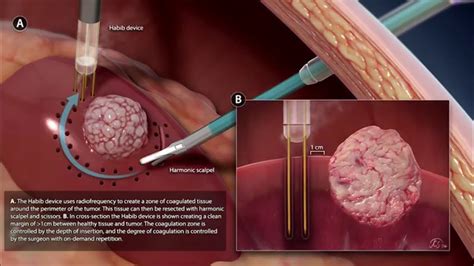 Image result for Hal Nephrectomy