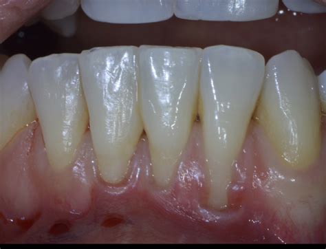 Tooth Recession 的图像结果