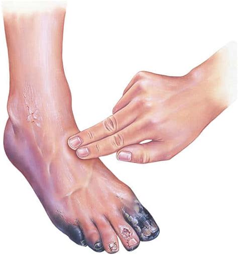 Diabetes and gangrene: डायबिटीज और गैंग्रीन का क्या है आपस में कनेक्शन ...