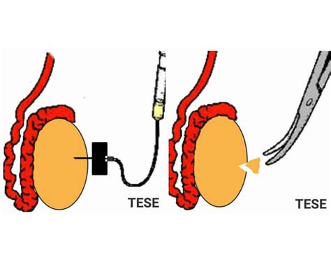 What is TESE/ TESA ICSI?