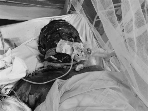 Dewas Accident: Blood Turning Watery, Survival Low for Critically Burnt ...