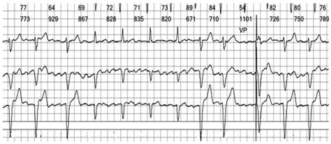 Wide Complex Irregular Rhythm in a Paced Patient: A Clinical Approach