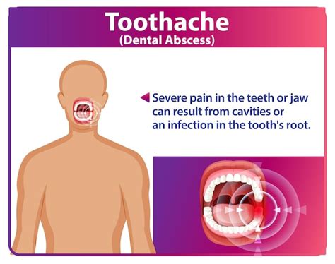 Toothache 的图像结果