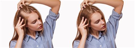 Female Hair Loss Solutions - MySkinCare.in