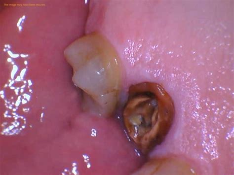 Image result for Root Extraction Tooth Broken Off