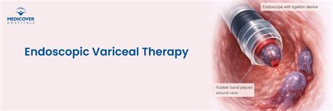 Endoscopic Variceal Therapy: Procedure & Recovery