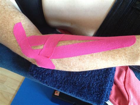 Kinesiology Tape Elbow Bursitis at Carly Decosta blog