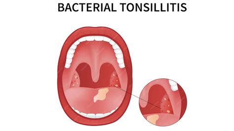 How is Tonsillitis Caused? – NutritionFact.in
