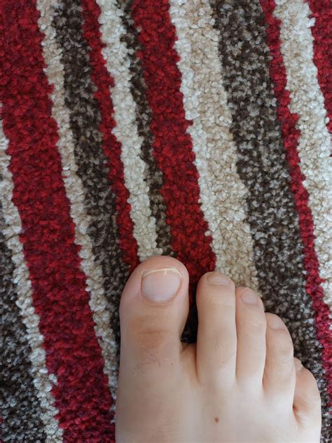 Big toe callus that does not go away! : r/DermatologyQuestions