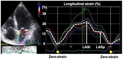 Echocardiographic Assessment of Atrial Function: From Basic Mechanics ...