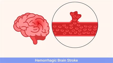 Blood Clot In The Brain: Intracranial Haemorrhage, Its Symptoms, And ...