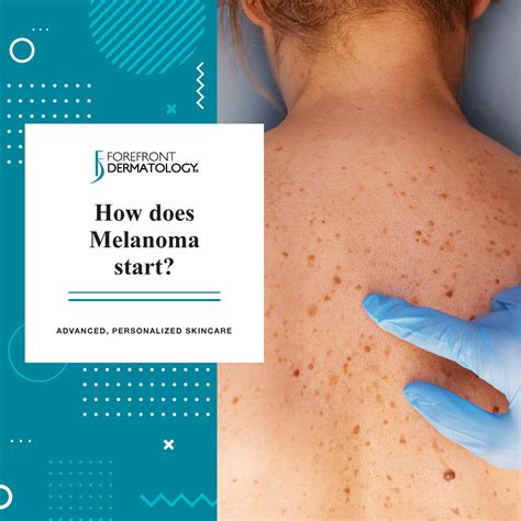 How Does Melanoma Start? - Forefront Dermatology