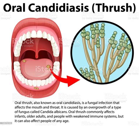 Oral Candidiasis Infographic With Explanation Stock Illustration ...