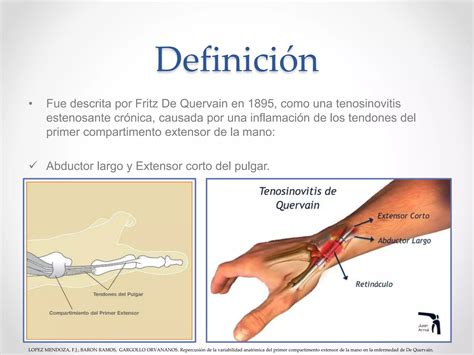 MANEJO QUIRÚRGICO DE LA tenosinovitis de quervain.pptx