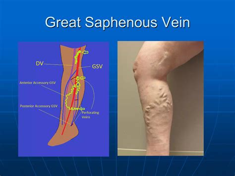The Great Saphenous Vein | PDF