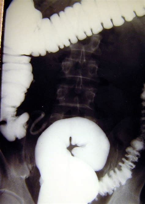 Colon Diverticular Disease 1820 Cecum Diverticulitis 7 | Surgery Photos