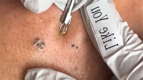 Image result for Largest Infected Exploding Cyst Carbuncle Blackhead
