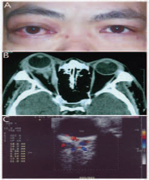 Concomitant Idiopathic Orbital Inflammatory Pseudotumor and ...