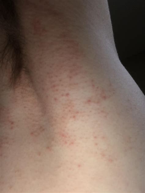 Why Do I Have A Red Rash Under My Armpits at Roy Wall blog