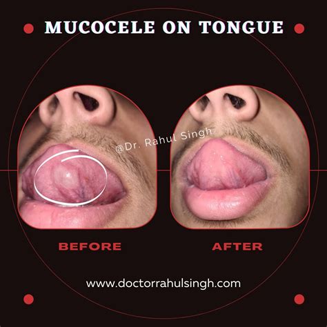Mucocele Under Tongue