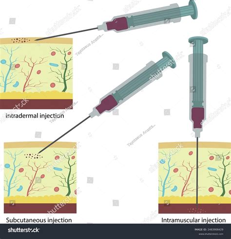 Injection Types 的图像结果