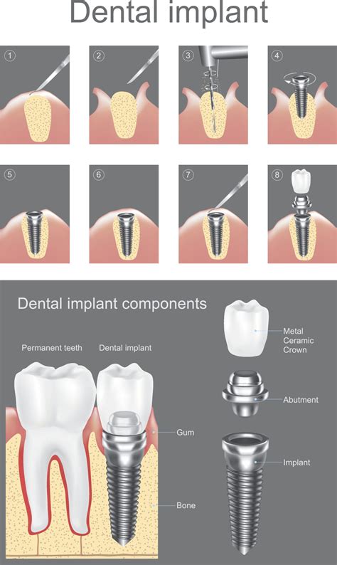 Tooth Implant Procedure